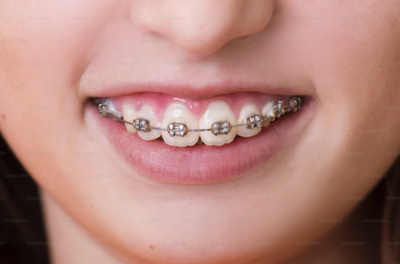 Ortodoncja – leczenie wad zgryzu u dzieci i dorosłych w Szczecinie