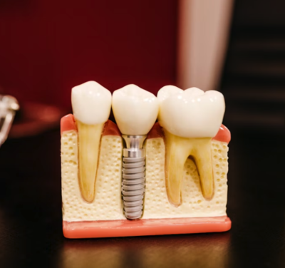 Wkłady koronowo-korzeniowe – odbudowa zęba po leczeniu kanałowym w Szczecinie